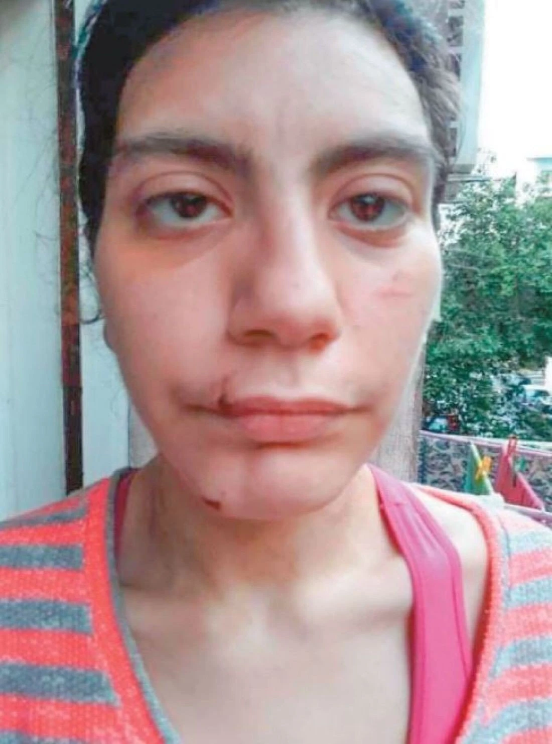 Η 23χρονη μετά από ξυλοδαρμό