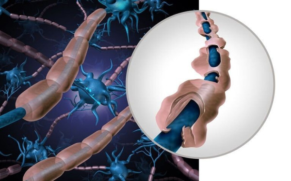  Ο ιός Επστάιν-Μπαρ φαίνεται να είναι η βασική αιτία της πολλαπλής σκλήρυνσης