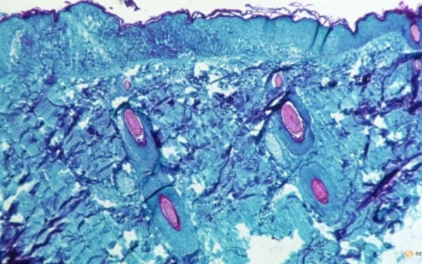 Ευλογιά των Πιθήκων: Ο ΠΟΥ αποφασίζει για κήρυξη κατάστασης έκτακτης ανάγκης
