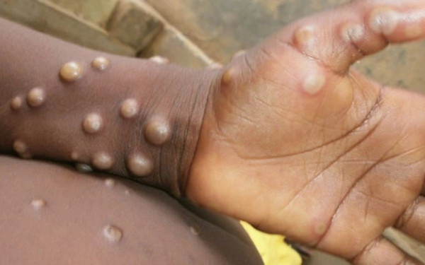 ΕΟΔΥ: 85 τα κρούσματα της ευλογιάς των πιθήκων στη χώρα μας - Το προφίλ των ασθενών