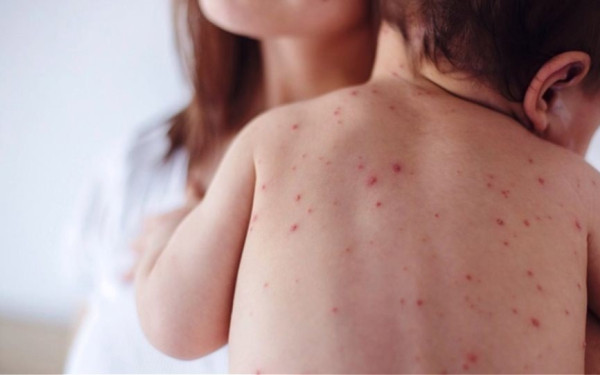 Πίσω ολοταχώς: Οι ξεχασμένες ασθένειες κάνουν δυναμικό... comeback