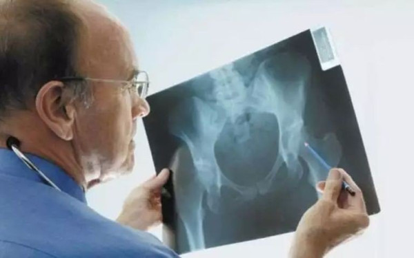 Καμπανάκι επιστημόνων για την οστεοπόρωση: Σχεδόν θα διπλασιαστούν τα κατάγματα ισχίου έως το 2050