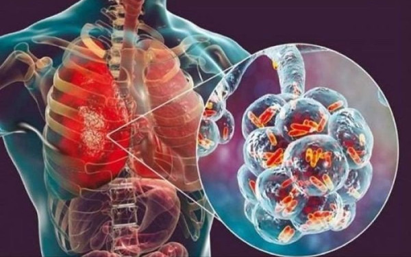 Η πρόγνωση, τα συμπτώματα και η αντιμετώπιση της πνευμονικής υπέρτασης	 Η πρόγνωση, τα συμπτώματα και η αντιμετώπιση της πνευμονικής υπέρτασης