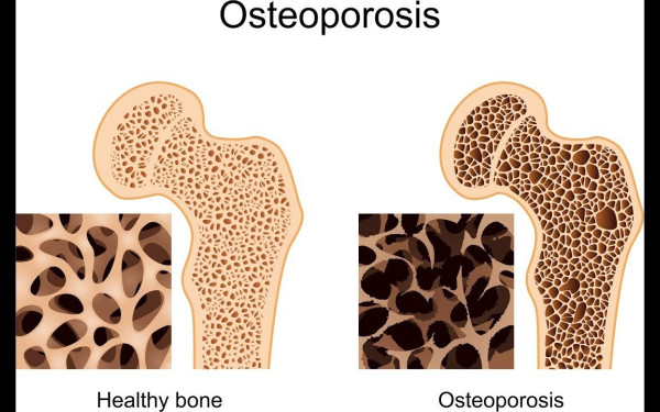 Διήμερη δράση προληπτικού ελέγχου και ενημέρωσης για την οστεοπόρωση στη Θεσσαλονίκη