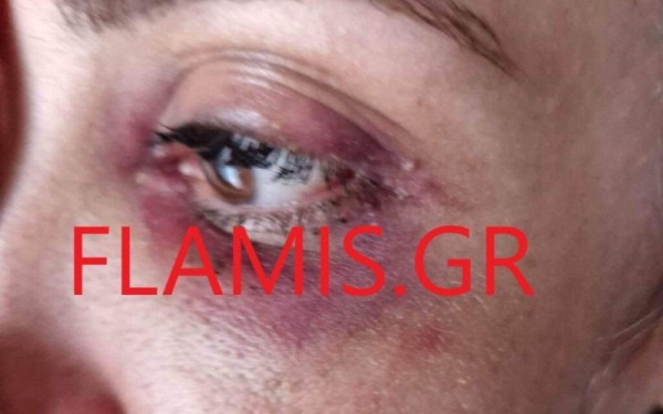 Πάτρα: «Μαύρισε» τη σύντροφό του στο ξύλο - «Θα σε σκοτώσω όταν βγω από τη φυλακή» (φωτ.)