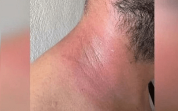 Καρδίτσα: Βούτηξε να βοηθήσει και μολύνθηκε από το νερό - Δείτε βίντεο