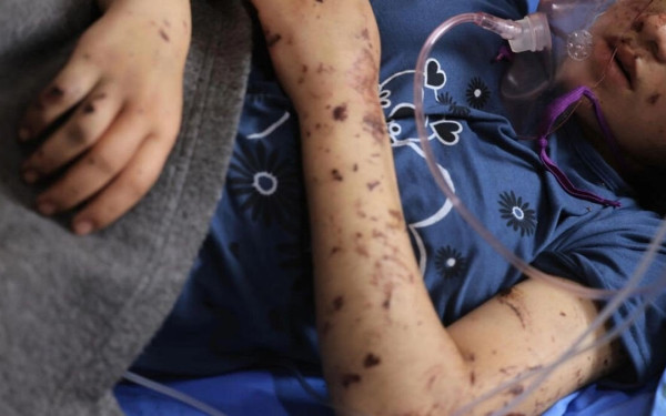 «Ξαναβάλτε μου τα πόδια μου» - Η φρίκη των ακρωτηριασμένων παιδιών στην εμπόλεμη Λωρίδα της Γάζας (βίντεο)