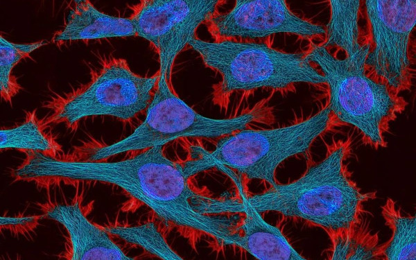 Τεχνητή Νοημοσύνη: Προβλέπει την ανταπόκριση του οργανισμού στη θεραπεία κατά του καρκίνου