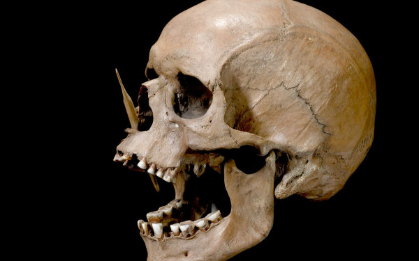 Σκλήρυνση κατά πλάκας: Aρχαίο DNA αποκαλύπτει το λόγο για τα υψηλά ποσοστά στην Ευρώπη 