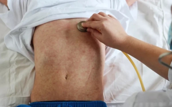 Παγώνη: Πιο μεταδοτική η ιλαρά από τον Covid - Γιατί είναι επικίνδυνη, τι πρέπει να κάνετε (βίντεο)