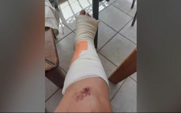 Ιταλία: Τελείωσε ο γύψος στο νοσοκομείο και ακινητοποίησαν σπασμένο πόδι σε χάρτινο κουτί