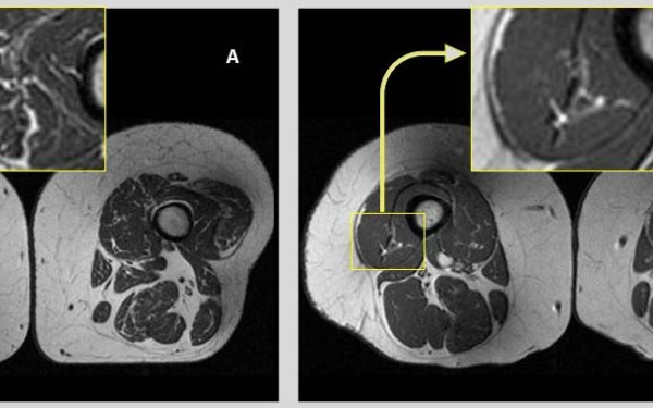 Υγεία: Η κατανάλωση πολύ επεξεργασμένων τροφίμων συνδέεται με υψηλότερη ποσότητα λίπους στους μύες