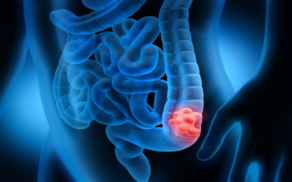 Καρκίνος Παχέος Εντέρου: Ποια η καλύτερη μέθοδος πρόληψης