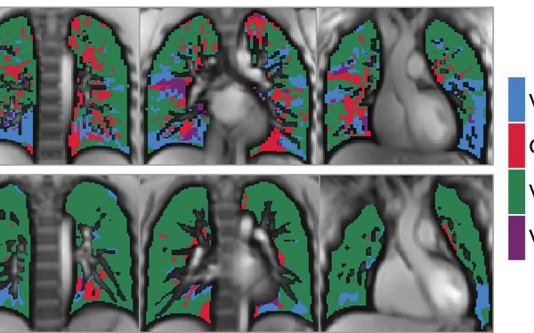 Πώς η long Covid μπορεί να επηρεάσει τους πνεύμονες των παιδιών