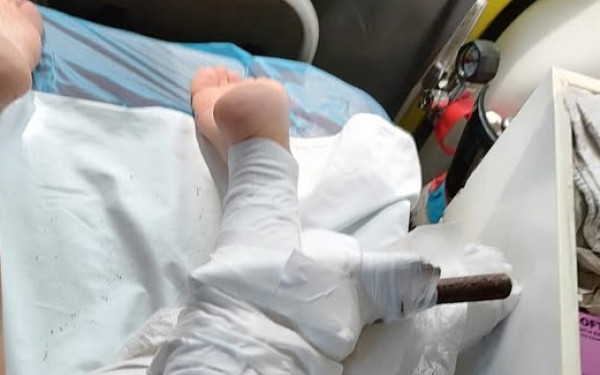 Χαλκιδική: Σκουριασμένη ομπρέλα καρφώθηκε στο πόδι λουόμενης στο Ποσείδι - Άμεση επέμβαση διασώστη του ΕΚΑΒ