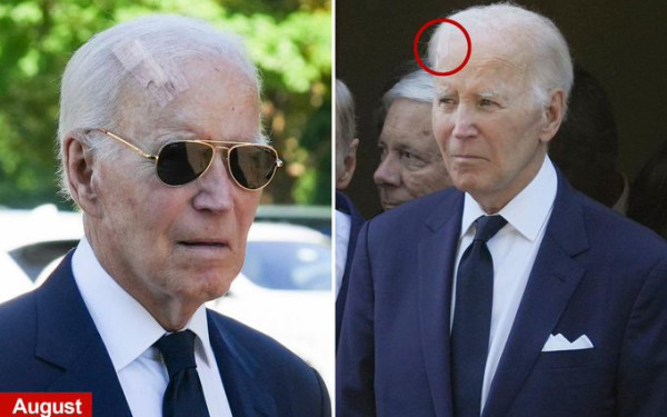 Τζο Μπάιντεν: Yποβλήθηκε σε χειρουργείο για καρκίνο του δέρματος