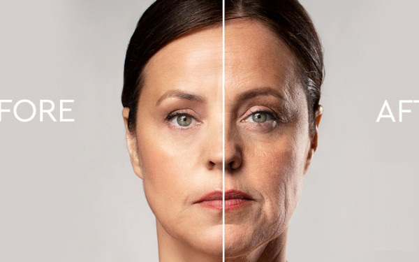 Ozempic Face: Όταν η γρήγορη απώλεια βάρους «αδειάζει» το πρόσωπο