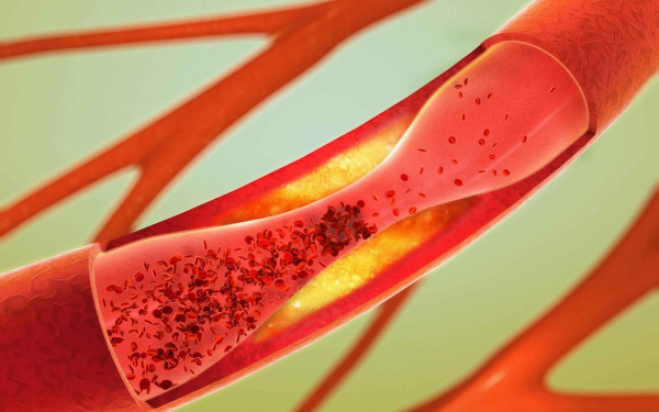 Παγκόσμια Ημέρα Θρόμβωσης: Κάθε έξι δευτερόλεπτα ένας άνθρωπος πεθαίνει από επιπλοκές θρόμβων Παγκόσμια Ημέρα Θρόμβωσης: Κάθε έξι δευτερόλεπτα ένας άνθρωπος πεθαίνει από επιπλοκές θρόμβων