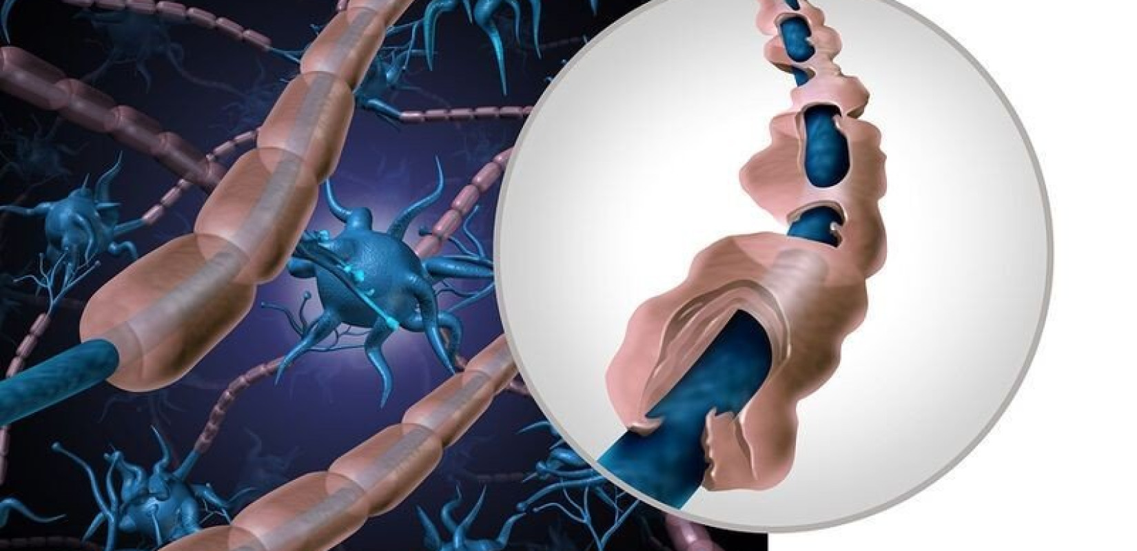  Ο ιός Επστάιν-Μπαρ φαίνεται να είναι η βασική αιτία της πολλαπλής σκλήρυνσης