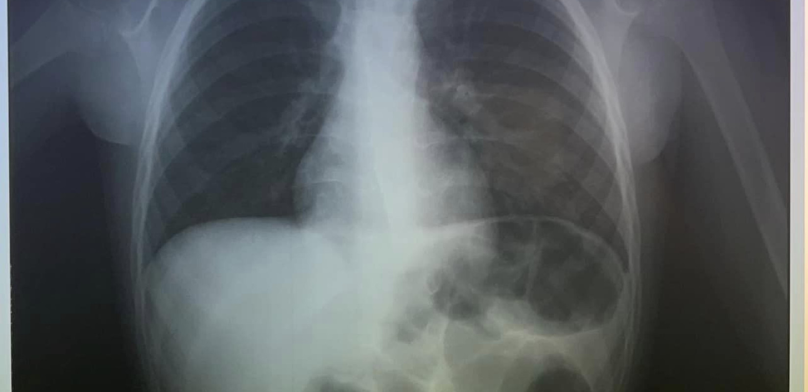 Κρήτη: Τετράχρονος κατάπιε κέρμα και δεν μπορούσε να αναπνεύσει