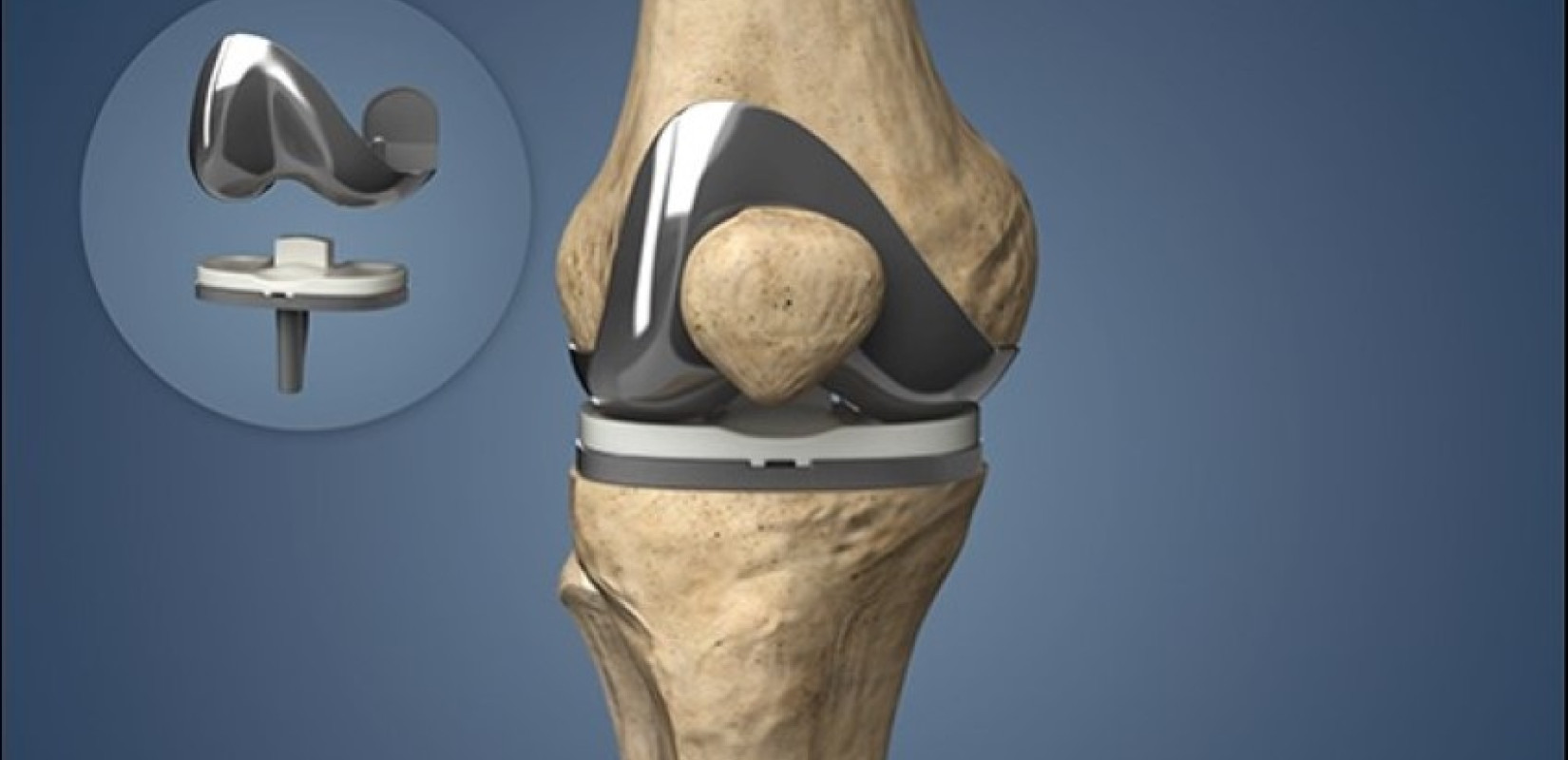 Ρομποτική αρθροπλαστική γόνατος: Είναι εδώ και ήρθε για να μείνει