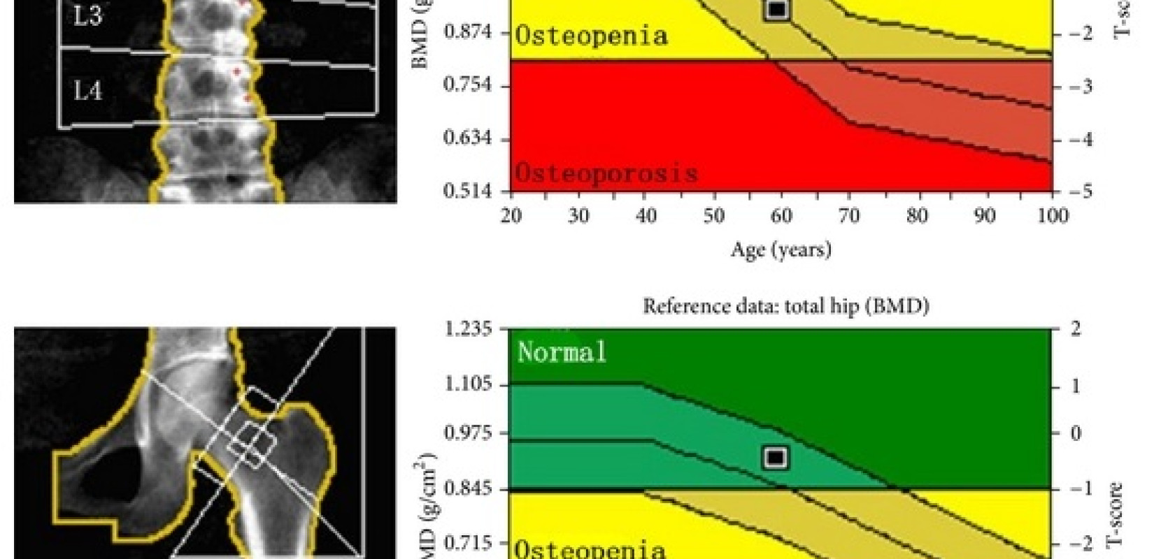 Δήμος Θέρμης: Δωρεάν μέτρηση οστικής πυκνότητας από το ΚΕΠ Υγείας - Το πρόγραμμα των εξετάσεων