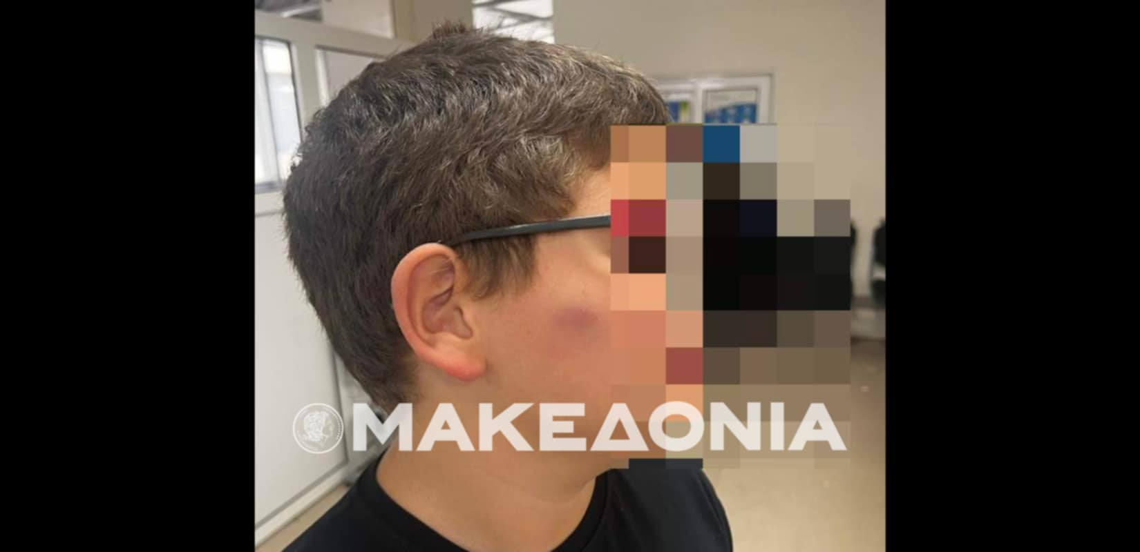 Θεσσαλονίκη: Ανήλικοι ξυλοκόπησαν 11χρονο μαθητή στο προαύλιο Δημοτικού Σχολείου