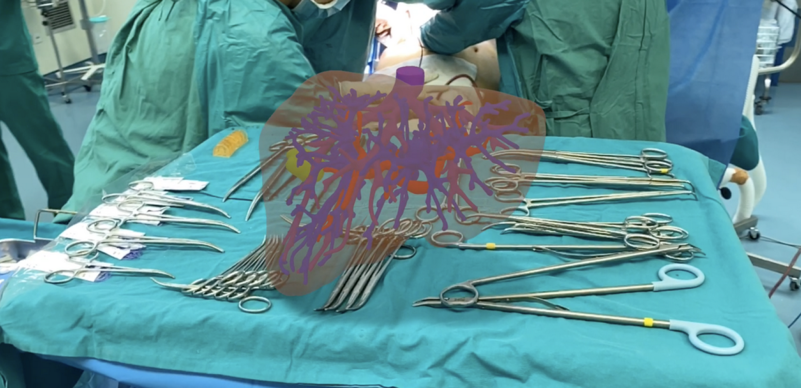 H Ελλάδα γύρισε σελίδα στις μεταμοσχεύσεις