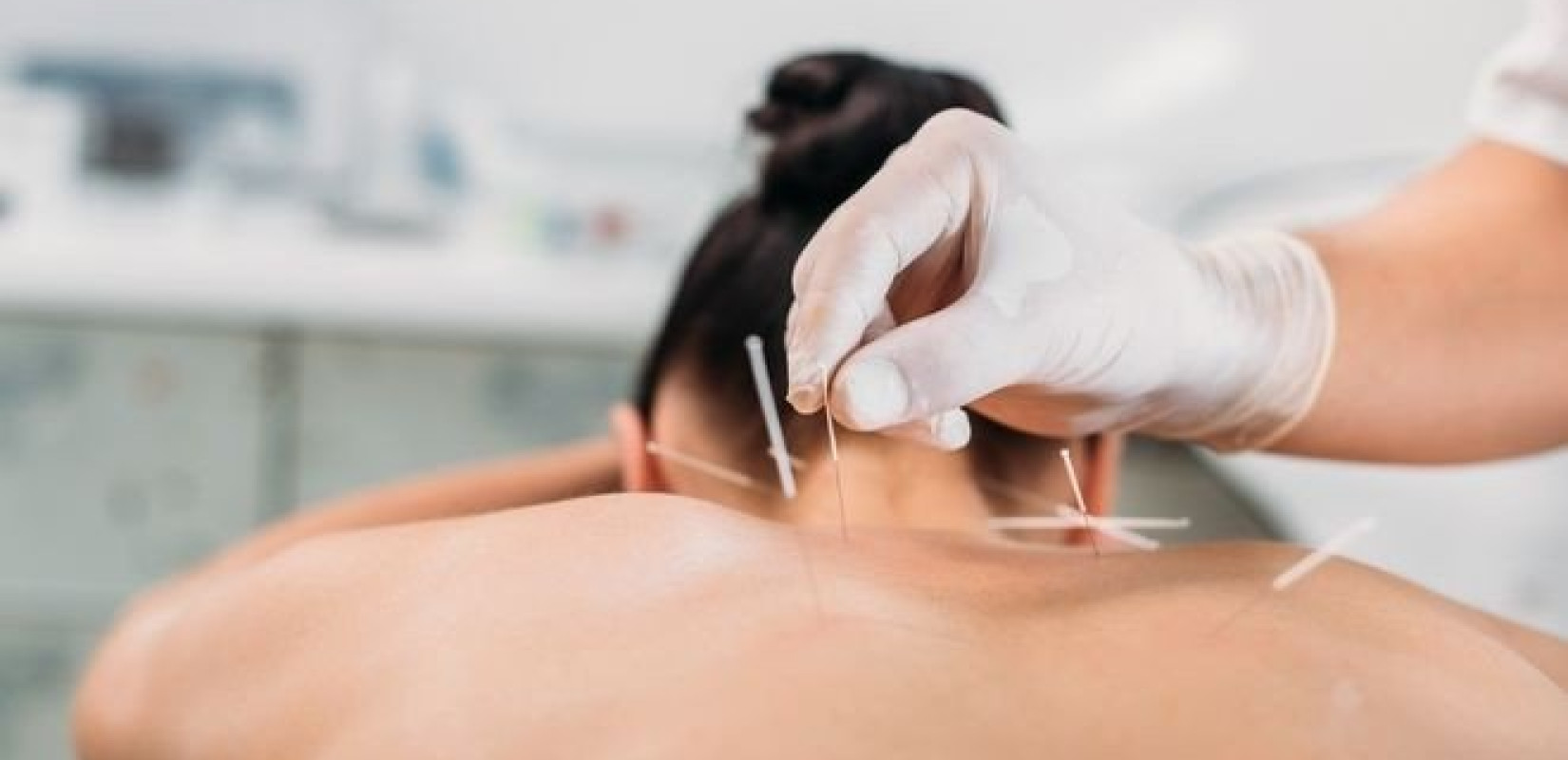 Ο βελονισμός περιορίζει το εγκεφαλικό που σχετίζεται με ρευματοειδή αρθρίτιδα