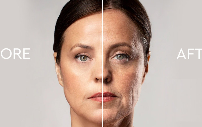 Ozempic Face: Όταν η γρήγορη απώλεια βάρους «αδειάζει» το πρόσωπο